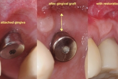 4.-Gum-gingival-graft-for-Inadequate-attached-gingiva-around-final-implant-kazemi-oral-surgery