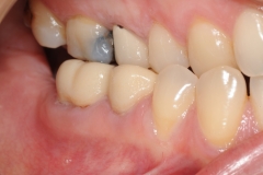1.-gingival-graft-for-gum-tissue-recession-kazemi-oral-surgey