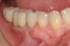 2.-gingival-graft-for-gum-tissue-recession-after-kazemi-oral-surgey