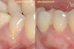 3.-gingival-graft-for-gum-tissue-recession-after-kazemi-oral-surgey