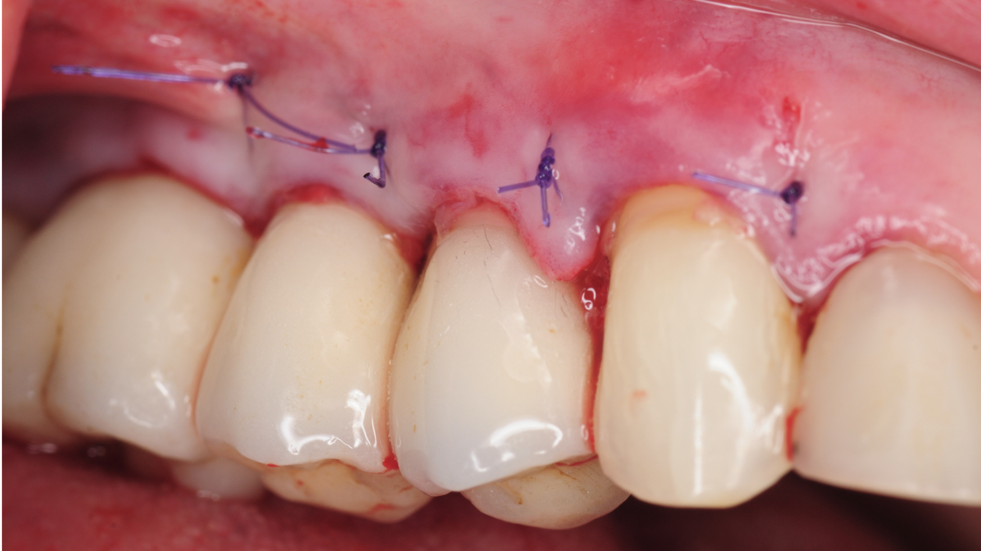 chronic-pain-dental-implant-peri-implantitis-mucositis-airflow-prophylaxis-master-kazemi-oral-surgery-11