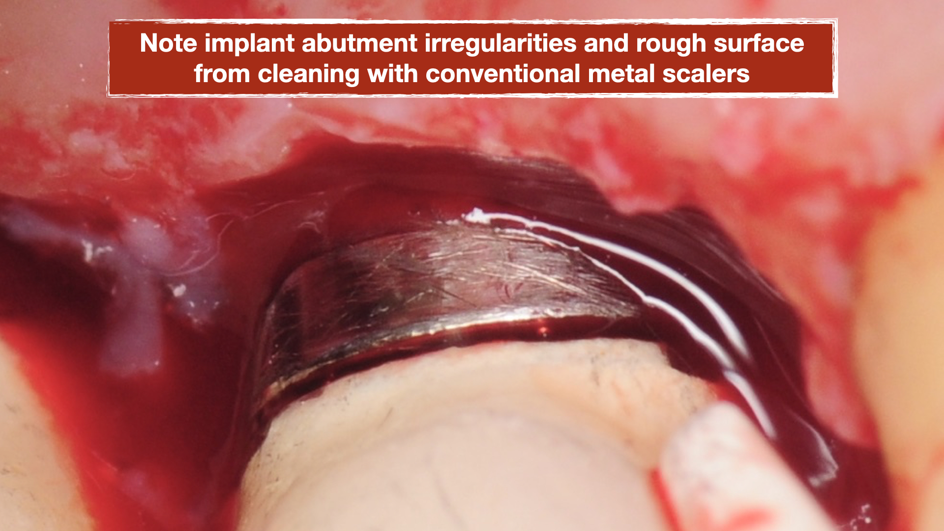 chronic-pain-dental-implant-peri-implantitis-mucositis-airflow-prophylaxis-master-kazemi-oral-surgery-8