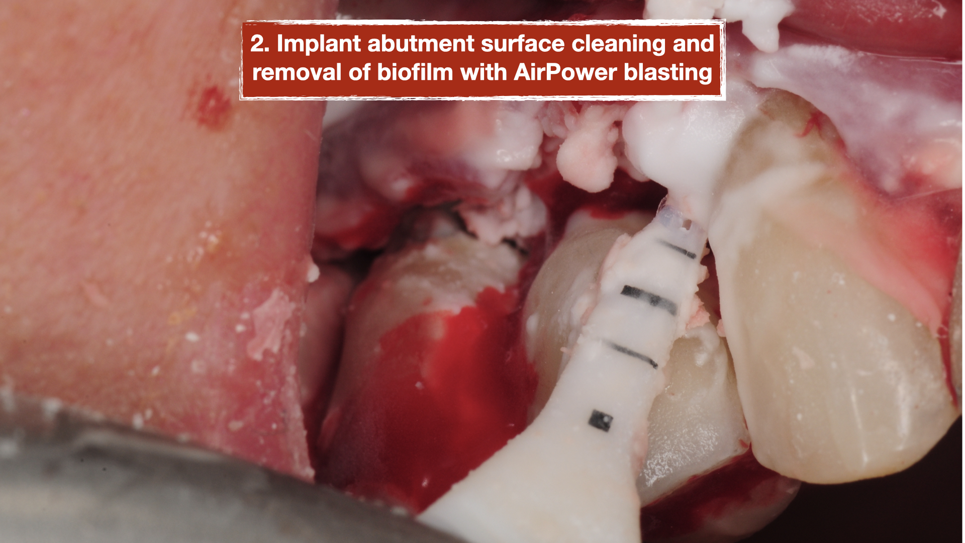chronic-pain-dental-implant-peri-implantitis-mucositis-airflow-prophylaxis-master-kazemi-oral-surgery-9