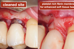 chronic-pain-dental-implant-peri-implantitis-mucositis-airflow-prophylaxis-master-kazemi-oral-surgery-10
