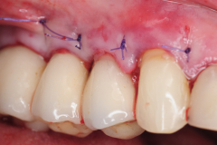 chronic-pain-dental-implant-peri-implantitis-mucositis-airflow-prophylaxis-master-kazemi-oral-surgery-11