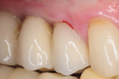 chronic-pain-dental-implant-peri-implantitis-mucositis-airflow-prophylaxis-master-kazemi-oral-surgery-2
