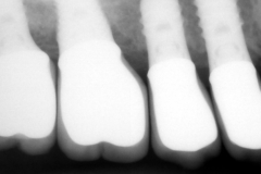 chronic-pain-dental-implant-peri-implantitis-mucositis-airflow-prophylaxis-master-kazemi-oral-surgery-3