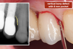 chronic-pain-dental-implant-peri-implantitis-mucositis-airflow-prophylaxis-master-kazemi-oral-surgery-4