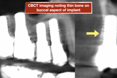 chronic-pain-dental-implant-peri-implantitis-mucositis-airflow-prophylaxis-master-kazemi-oral-surgery-5