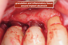 chronic-pain-dental-implant-peri-implantitis-mucositis-airflow-prophylaxis-master-kazemi-oral-surgery-6