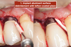 chronic-pain-dental-implant-peri-implantitis-mucositis-airflow-prophylaxis-master-kazemi-oral-surgery-7