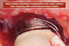 chronic-pain-dental-implant-peri-implantitis-mucositis-airflow-prophylaxis-master-kazemi-oral-surgery-8