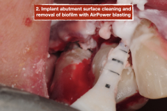 chronic-pain-dental-implant-peri-implantitis-mucositis-airflow-prophylaxis-master-kazemi-oral-surgery-9
