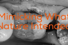 1.2 kazemi oral surgery dental implant dentist connective tissue graft