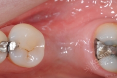 1.3. dental implant connective tissue graft kazemi oral surgery