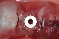 10. dental implant connective tissue graft kazemi oral surgery