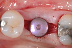 11. dental implant connective tissue graft kazemi oral surgery