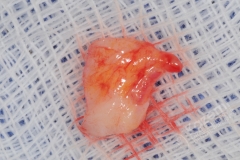 12. dental implant connective tissue graft kazemi oral surgery