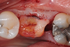 13. dental implant connective tissue graft kazemi oral surgery