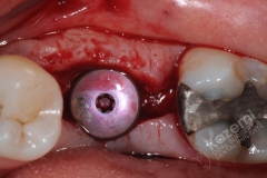 14.1. dental implant connective tissue graft kazemi oral surgery