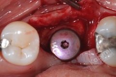 14.2. dental implant connective tissue graft kazemi oral surgery
