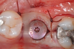 14.3. dental implant connective tissue graft kazemi oral surgery. dental implant connective tissue graft kazemi oral surgery