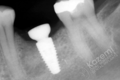 15. dental implant connective tissue graft kazemi oral surgery