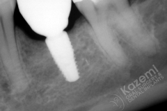 16. dental implant connective tissue graft kazemi oral surgery
