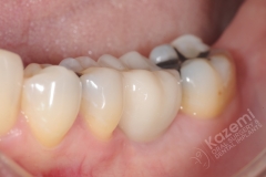 18. dental implant connective tissue graft kazemi oral surgery