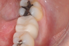 19. dental implant connective tissue graft kazemi oral surgery