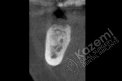 2. dental implant connective tissue graft kazemi oral surgery