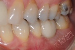 20. dental implant connective tissue graft kazemi oral surgery