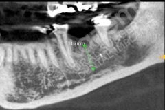 3. dental implant connective tissue graft kazemi oral surgery