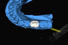 5. dental implant connective tissue graft kazemi oral surgery