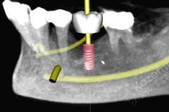 6. dental implant connective tissue graft kazemi oral surgery