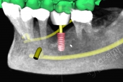 6.1. dental implant connective tissue graft kazemi oral surgery
