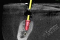 7. dental implant connective tissue graft kazemi oral surgery