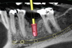 8. dental implant connective tissue graft kazemi oral surgery