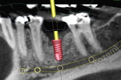 8. dental implant connective tissue graft kazemi oral surgery