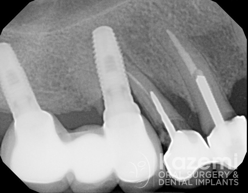 1dental implant complication poor placement kazemi oral surgery04