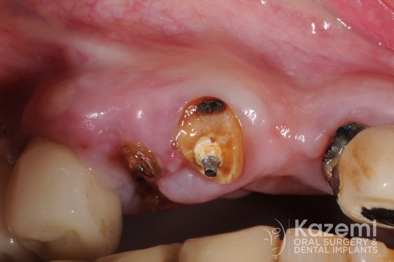 4.dental implant complication poor placement kazemi oral surgery00