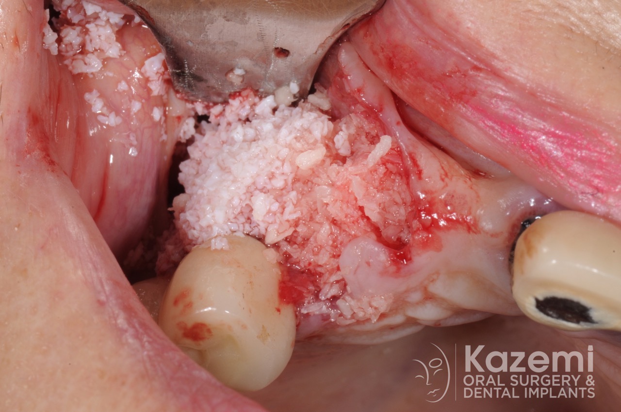 6.dental implant complication poor placement kazemi oral surgery00