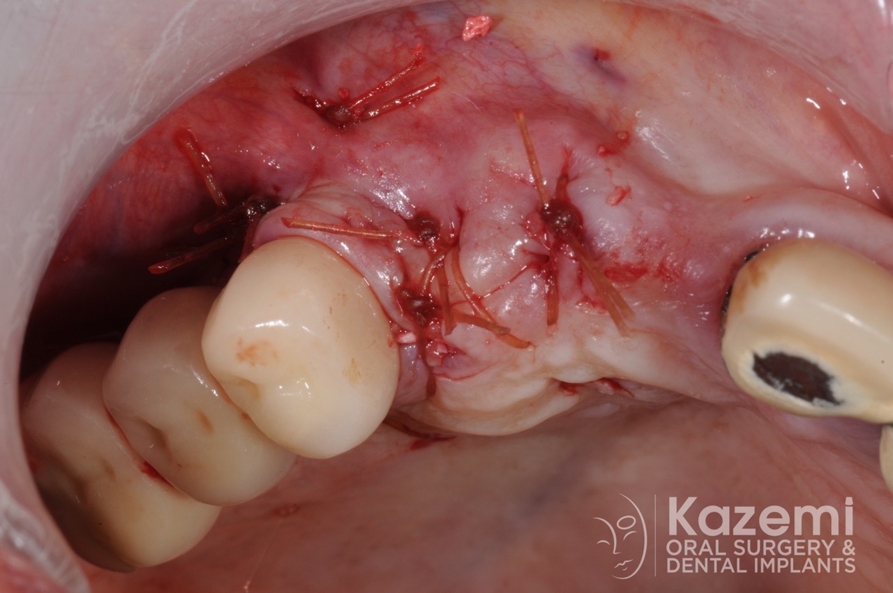7.dental implant complication poor placement kazemi oral surgery01
