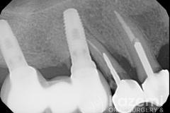 1dental implant complication poor placement kazemi oral surgery04