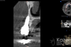 2.dental implant complication poor placement kazemi oral surgery02