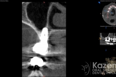 3.dental implant complication poor placement kazemi oral surgery03