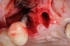 5.dental implant complication poor placement kazemi oral surgery01