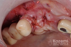 7.dental implant complication poor placement kazemi oral surgery01