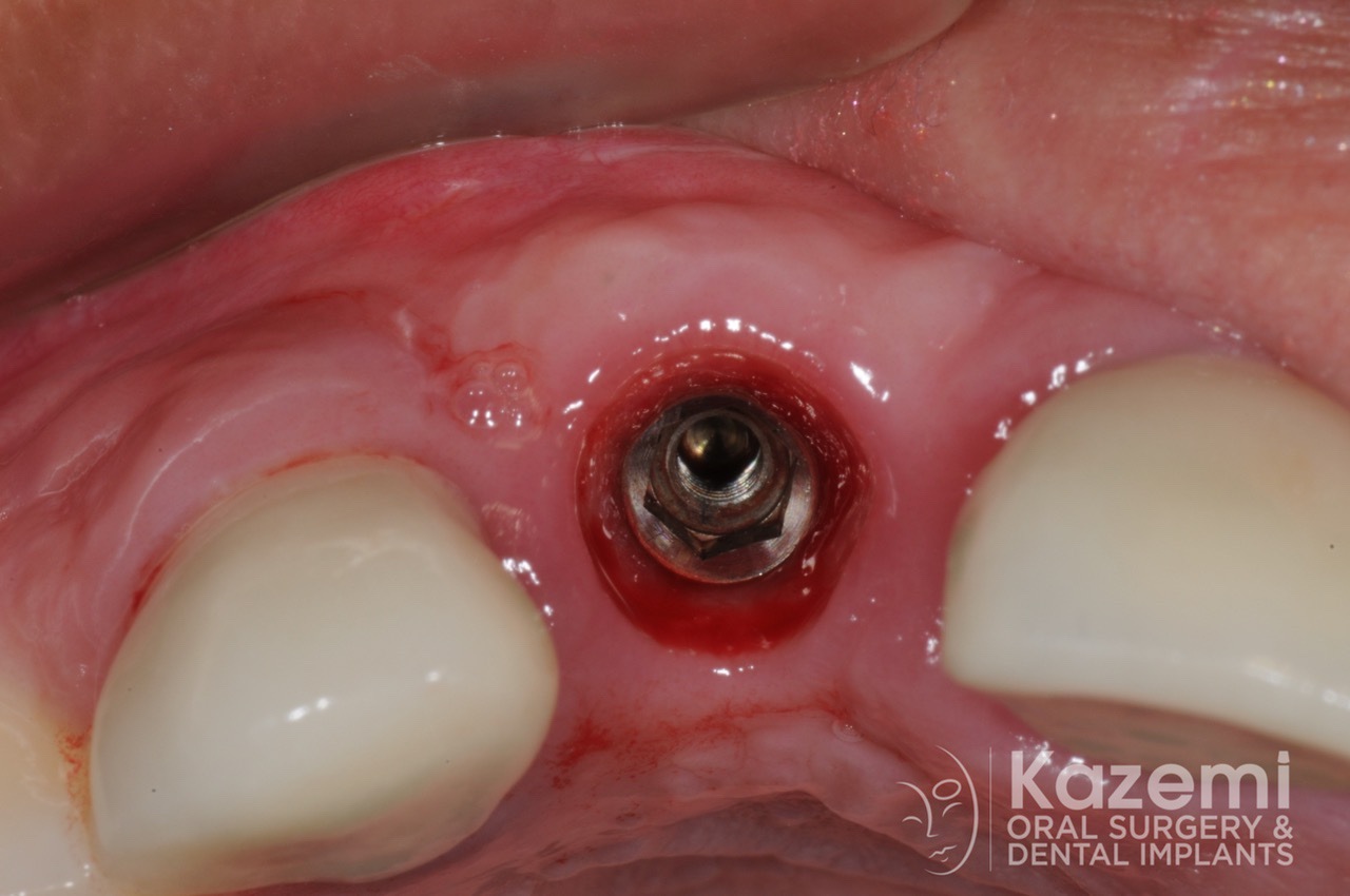 15dental implant complication kazemi oral surgery