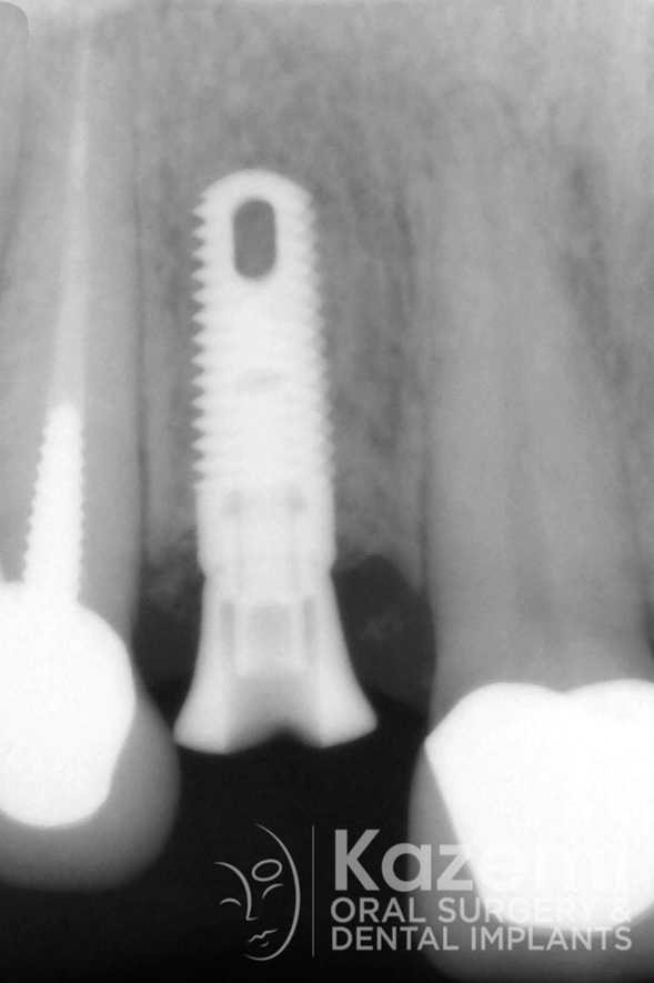 16dental implant complication kazemi oral surgery